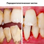 Photos before and after periodontal cleaning