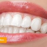 Photo of aligners on teeth