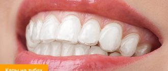 Photo of aligners on teeth