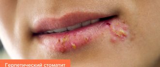 Photo of herpetic stomatitis