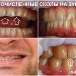 Photos of numerous chips on the teeth at the time of contacting the clinic. Attending physician - orthopedist Sergey Samsakov 