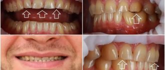 Photos of numerous chips on the teeth at the time of contacting the clinic. Attending physician - orthopedist Sergey Samsakov 