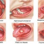 Photos of different types of stomatitis