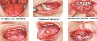 Photos of different types of stomatitis