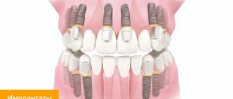 Photos of installed dental implants