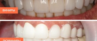 Photos of veneers and lumineers on teeth