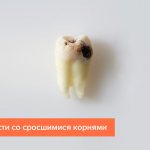 Фото зуба мудрости со сросшимися корнями