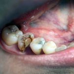 гемисекция зуба