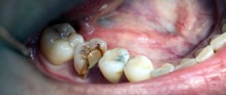 гемисекция зуба