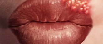 Herpes on the lips