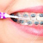 hygiene procedures with braces