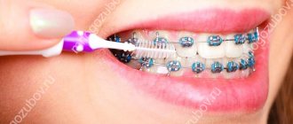 hygiene procedures with braces