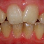 hyperplasia of tooth enamel in children