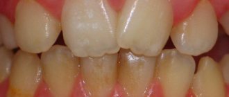 гиперплазия эмали зубов у детей