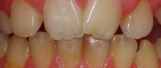 hyperplasia of tooth enamel in children