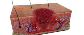 granulation tissue