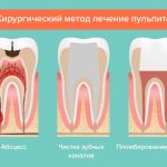 Surgical method for treating pulpitis in pictures