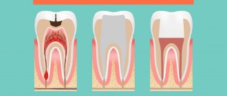 Surgical method for treating pulpitis in pictures