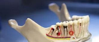 chronic form of granulating periodontitis