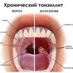 chronic tonsillitis