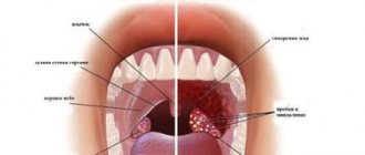 chronic tonsillitis