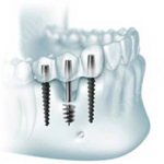 oneway biomed implant