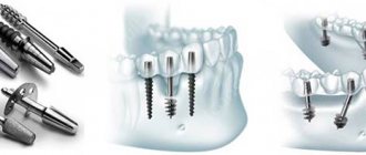 oneway biomed implant