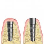 Dental implants Inno