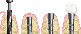 Dental implants Inno