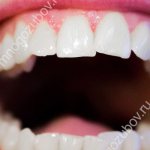 Искривленные зубы у пациента