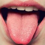 Why does your tongue itch?