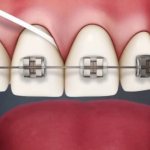 how to use dental floss with braces, clean until shiny