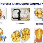 How do Ney system clasps work?