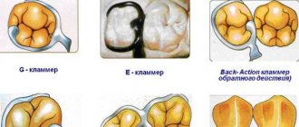 Как работают кламмеры системы Нея