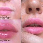 How to relieve swelling after lip augmentation with hyaluronic acid