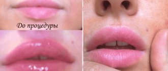 How to relieve swelling after lip augmentation with hyaluronic acid