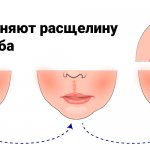 Как устраняют расщелину губы и неба