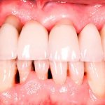 what does periodontal disease look like?