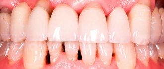 what does periodontal disease look like?