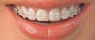 Which braces are better to install?