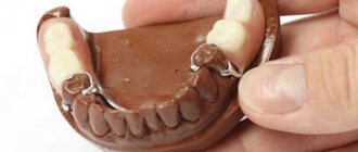 Which clasp dentures are better for teeth?