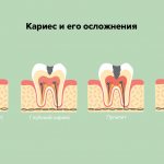 Кариес и его осложнения в картинках