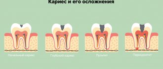 Caries and its complications in pictures