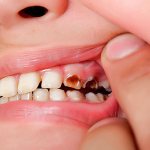 Кариес может быть причиной подвижности зуба