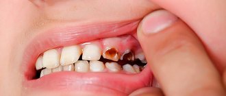 Caries can cause tooth mobility
