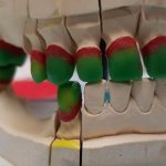 Classic modeling of crowns and bridges for metal-ceramics of the frontal and chewing group