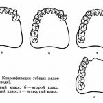 Kennedy classification