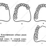 Классификация зубных рядов по Кеннеди