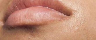 Comedon on the lip. What are blackheads around the lips? 