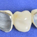 Metal-ceramic crowns